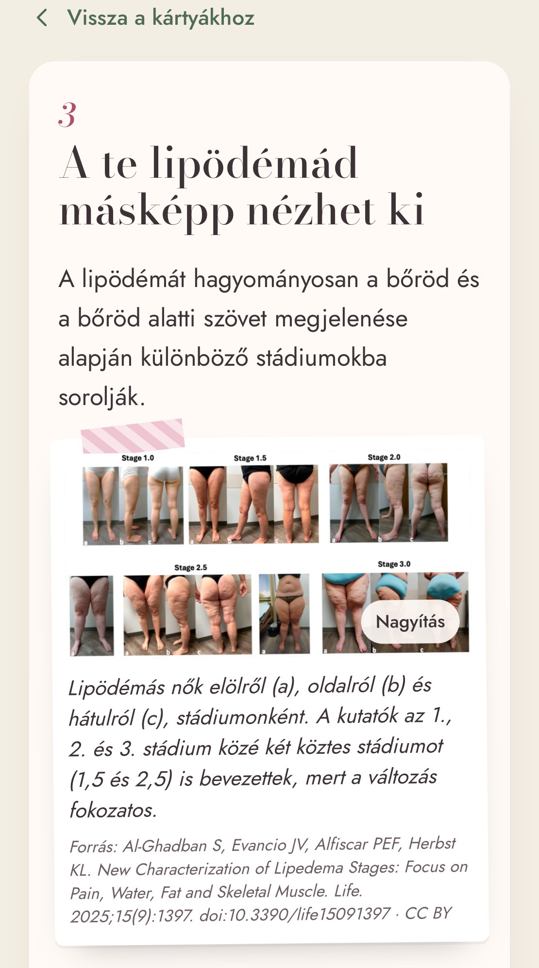 Egy kártya a lipödéma stádiumait bemutató kutatási fotókkal.
